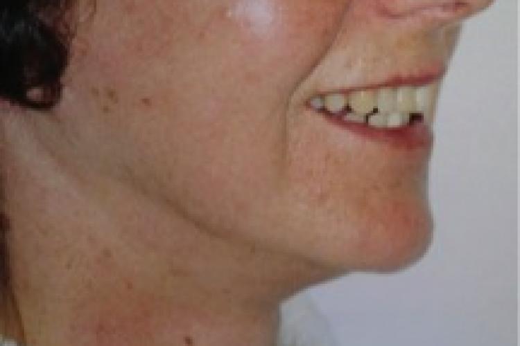 Full facelift na